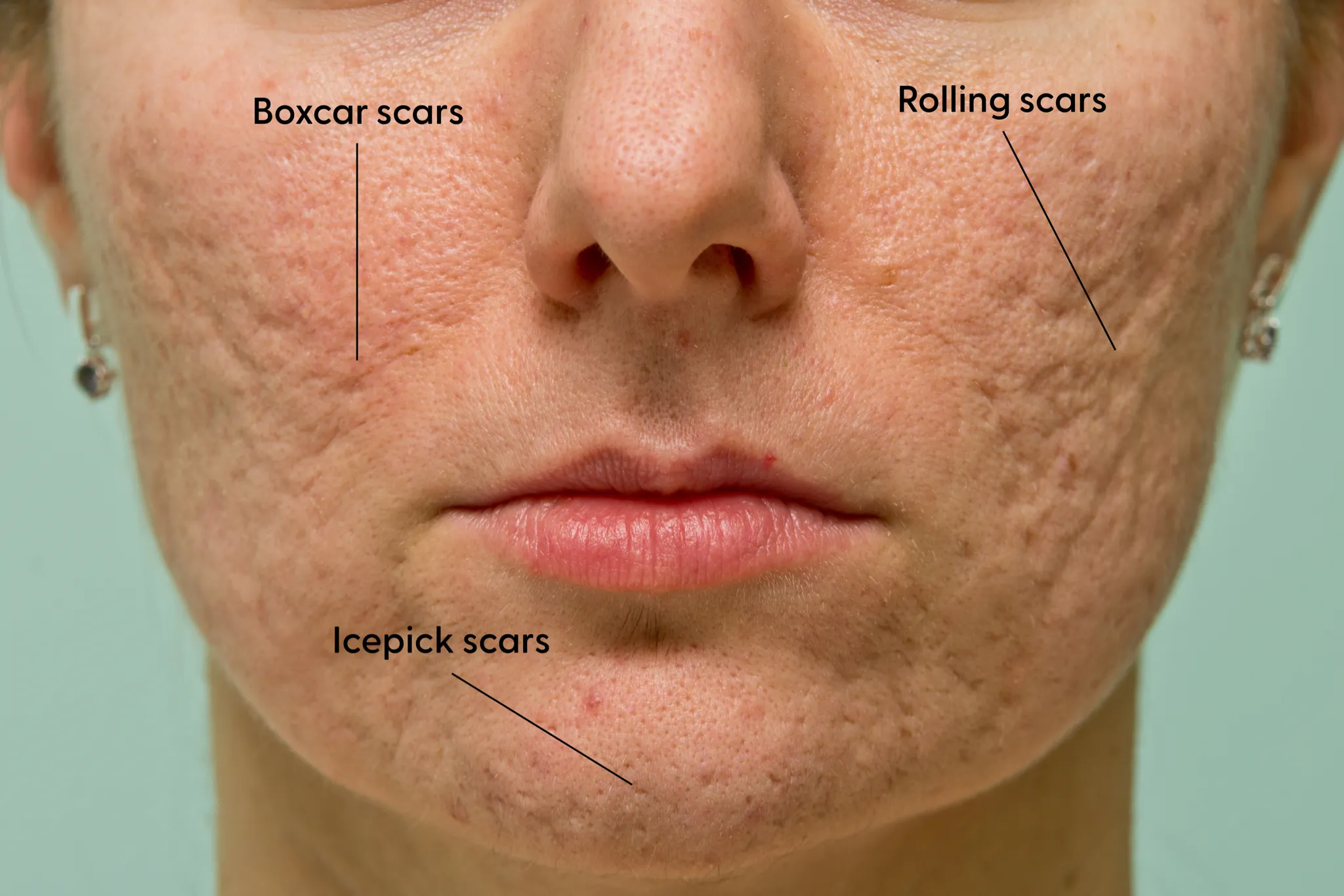 Different types of atrophic scars
