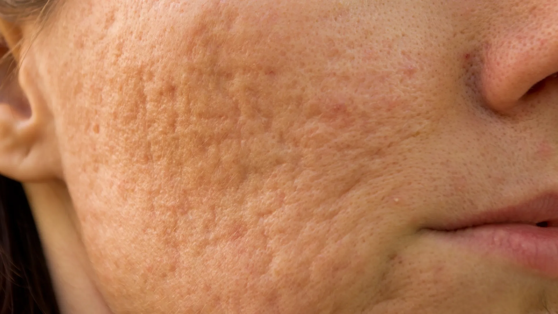 Πρόσωπο με ουλές ακμής