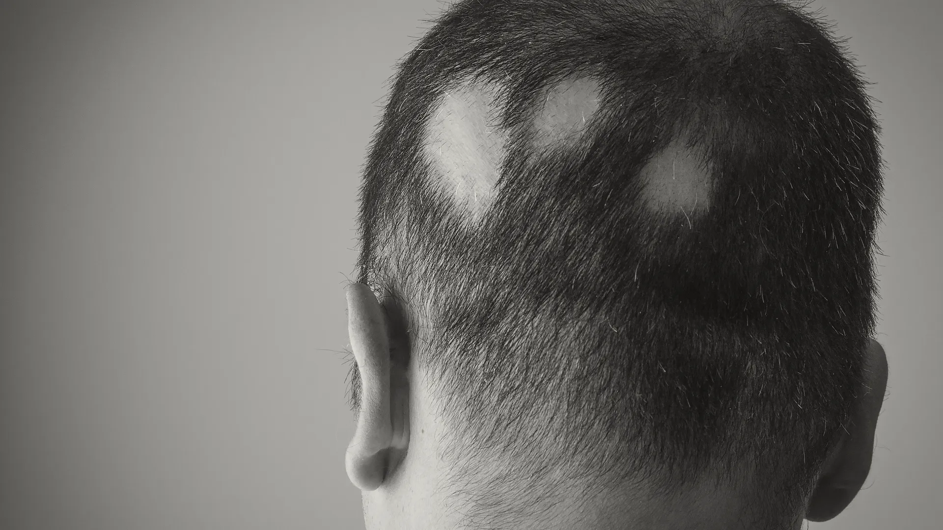 Γυροειδής αλωπεκία στο τριχωτό της κεφαλής