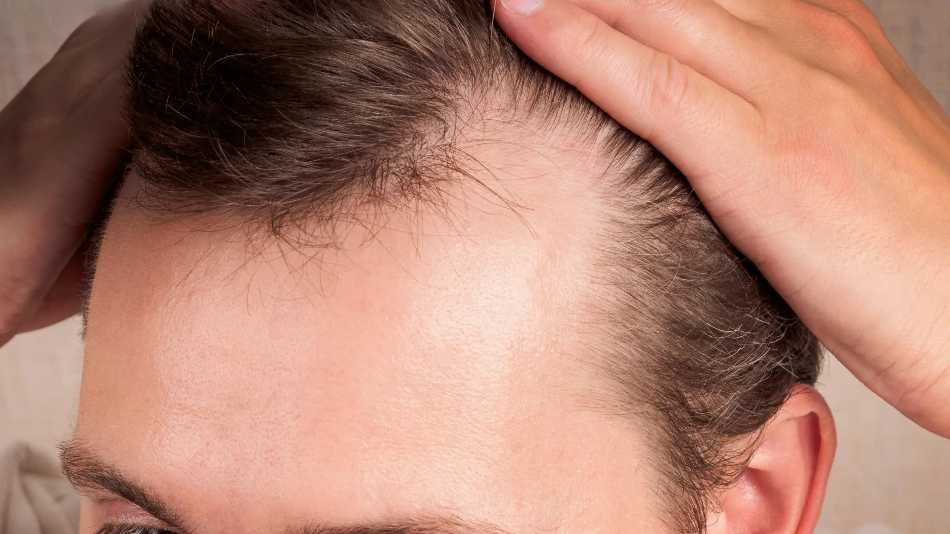 Αραίωση μαλλιών στους κροτάφους