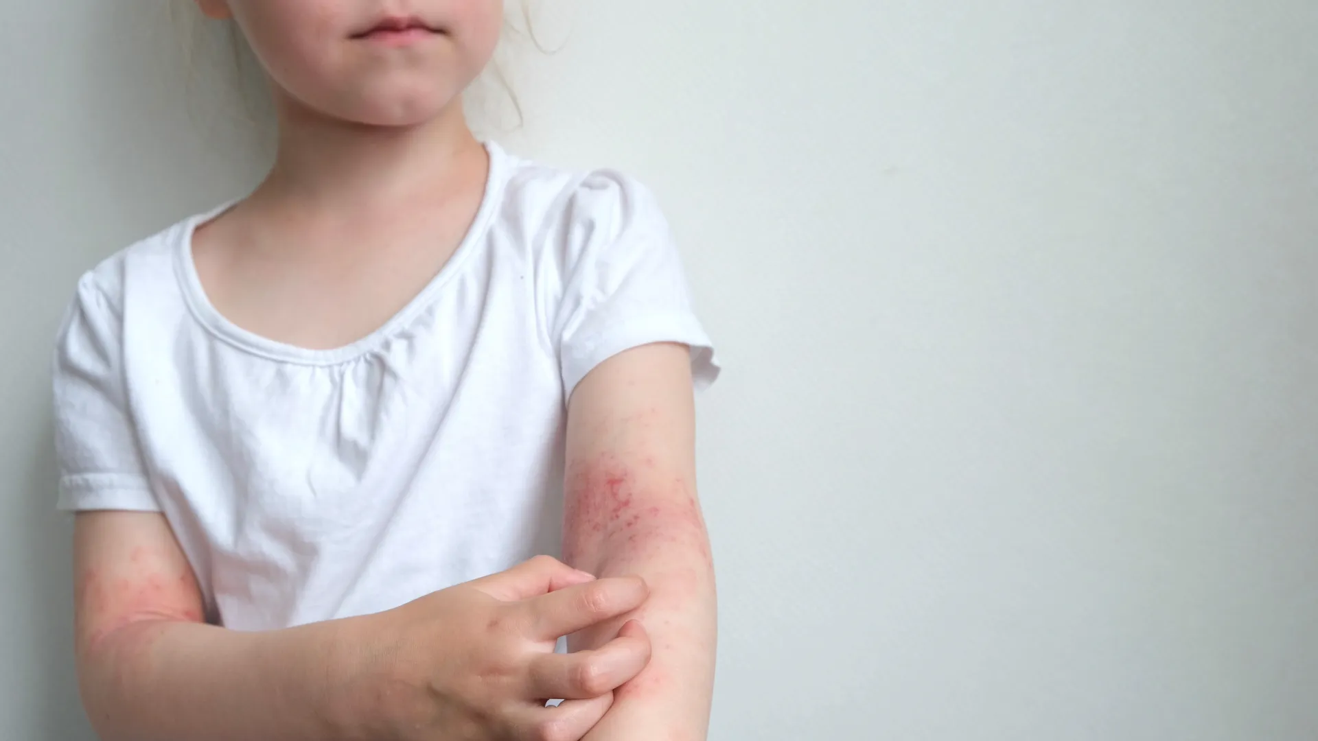 Ατοπική δερματίτιδα στο εσωτερικό του αγκώνα ενός παιδιού