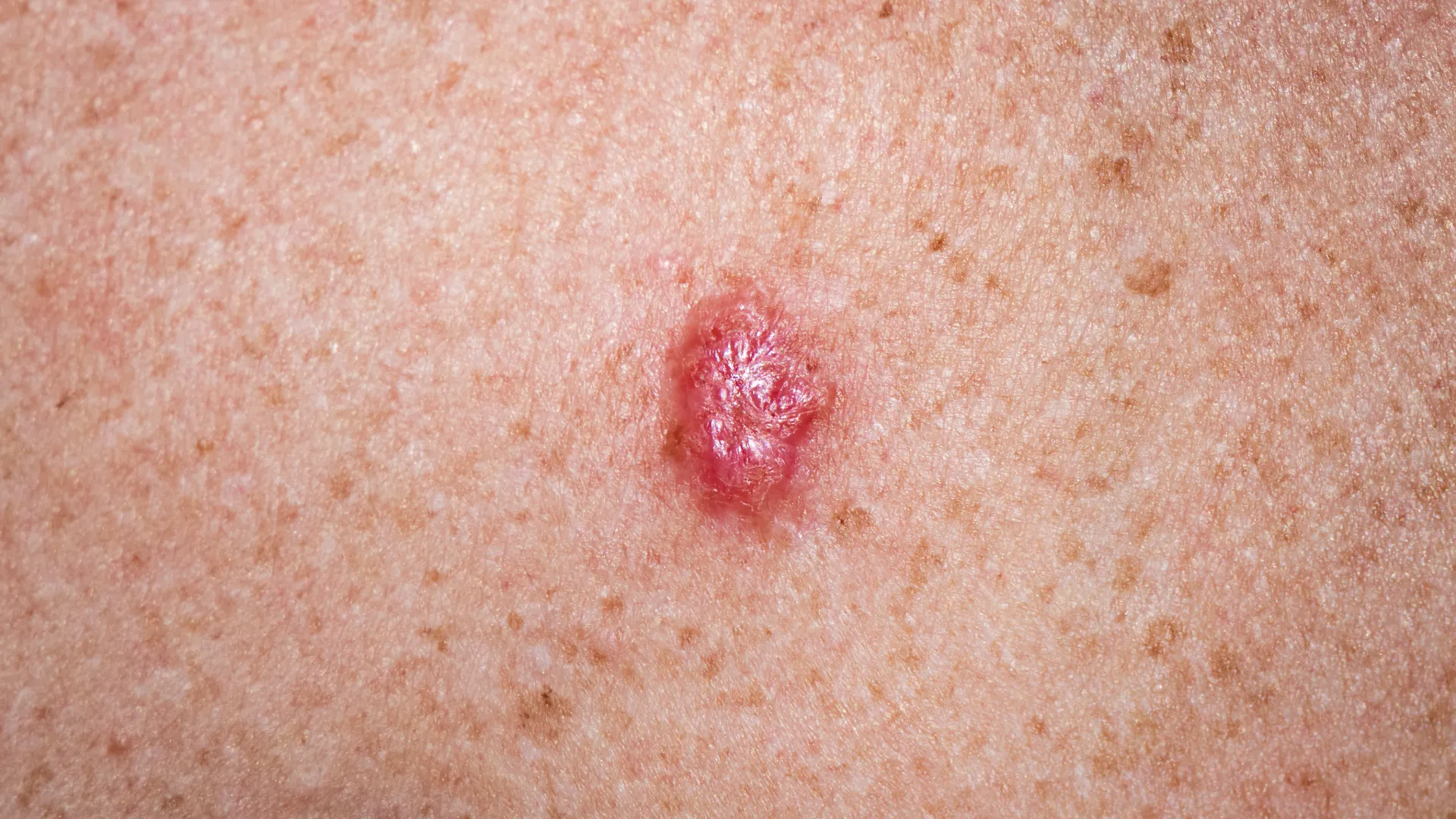 Βασικοκυτταρικό καρκίνωμα στο δέρμα