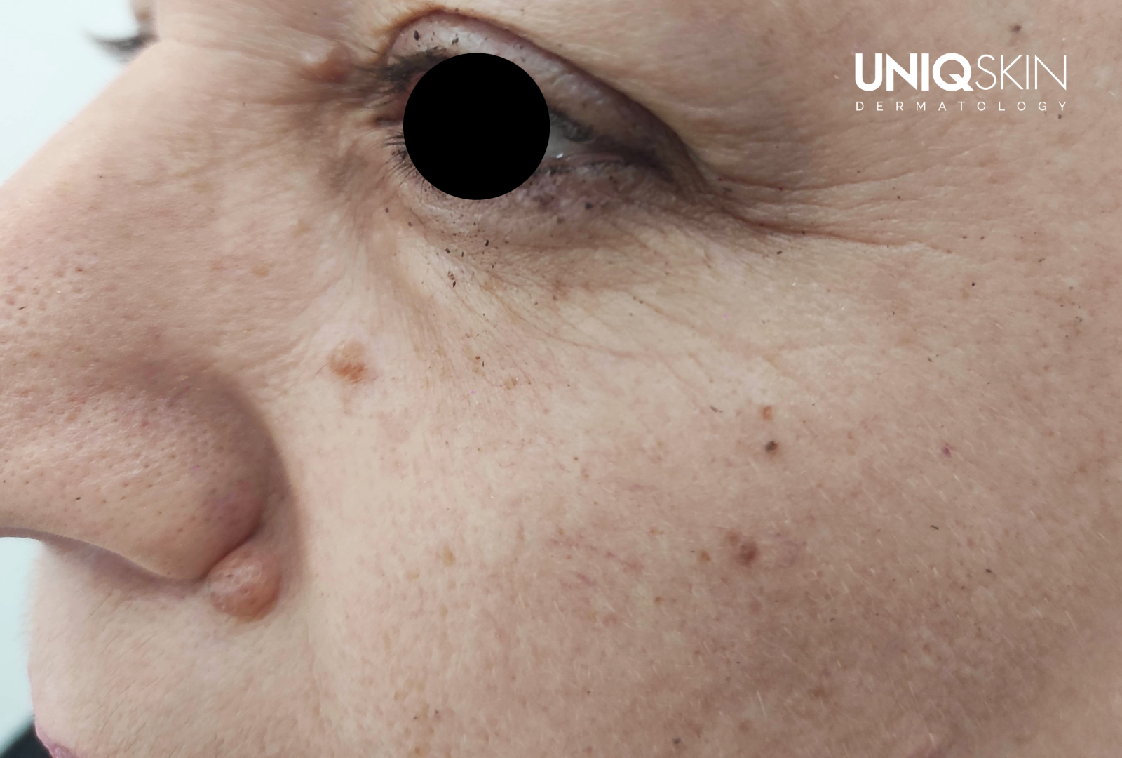 Πριν τη θεραπεία - αφαίρεση χοριακού σπίλου και μεσοθεραπεία