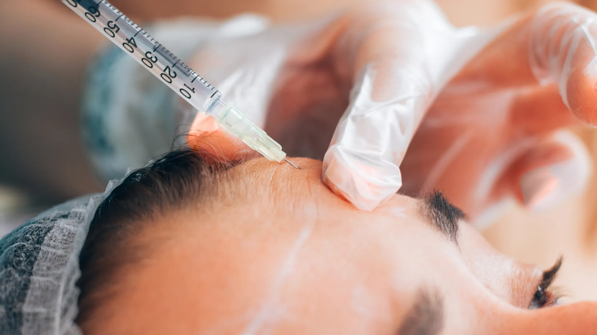 Εφαρμογή Botox στο μέτωπο