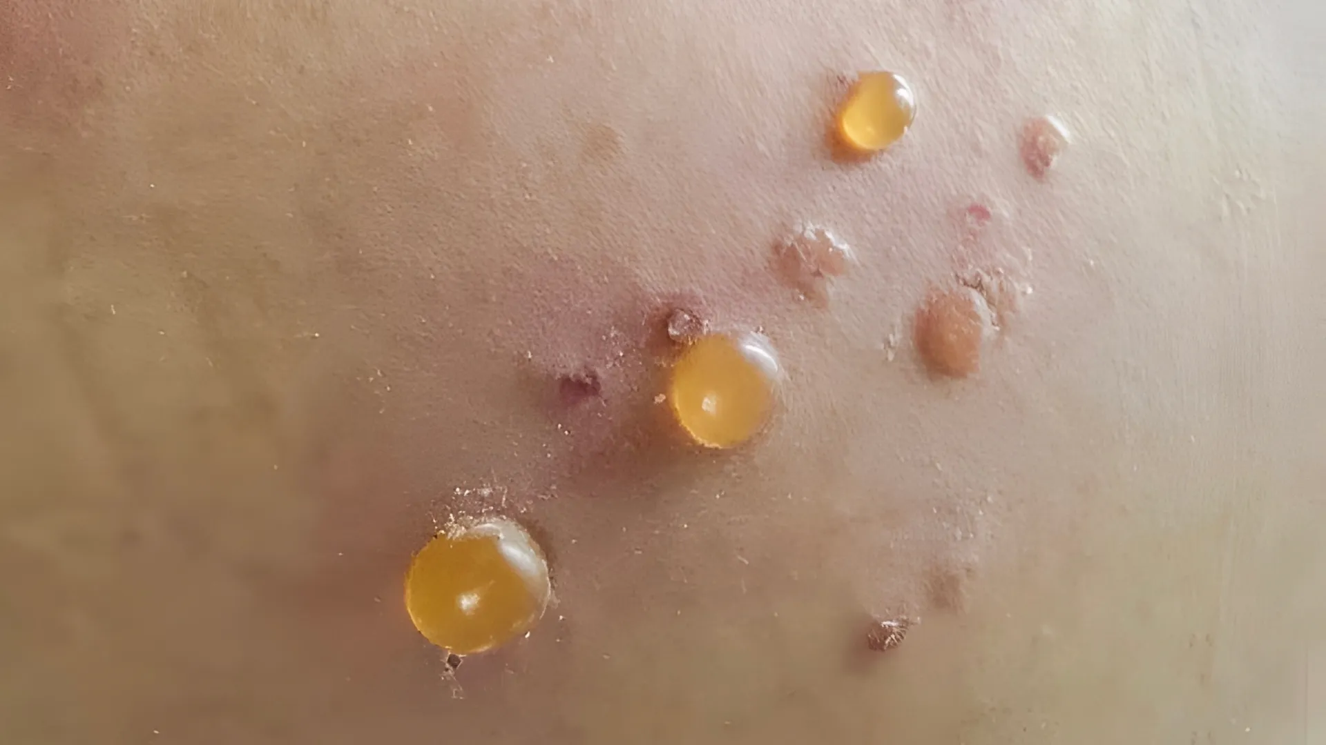 Πομφολυγώδες πεμφιγοειδές στο δέρμα