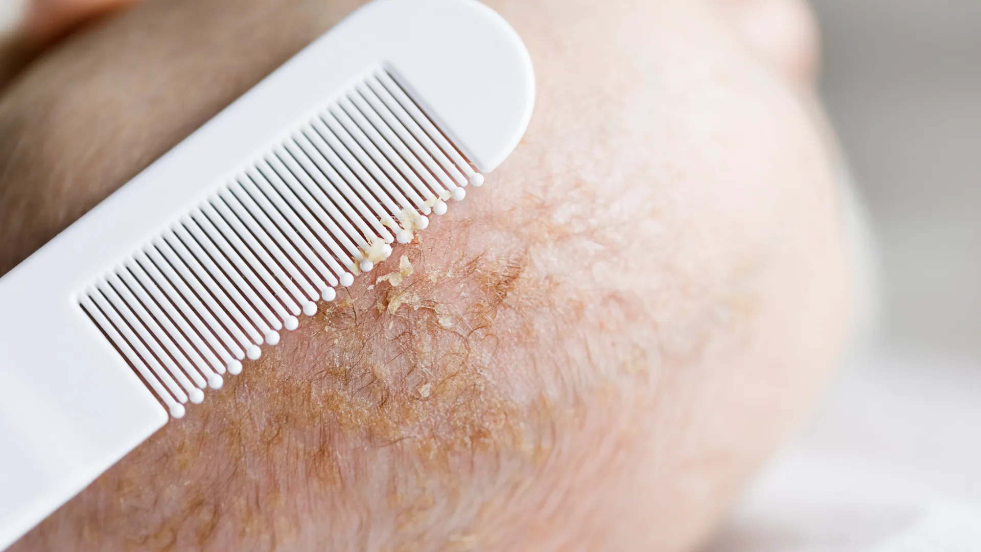 Νινίδα στο κεφάλι ενός μωρού