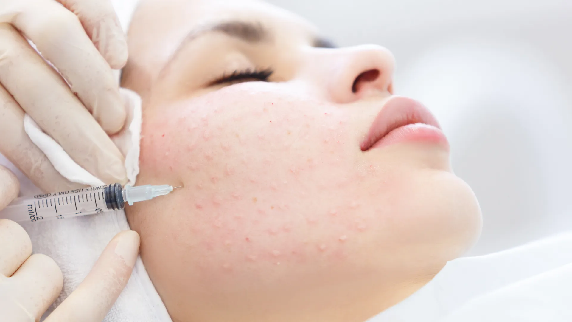 Μεσοθεραπεία προσώπου