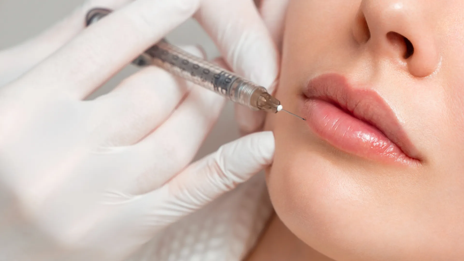 Εφαρμογή filler υαλουρονικού οξέος στα χείλη