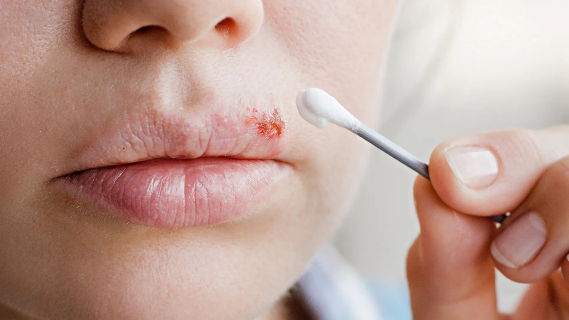 Έρπης στα χείλη μιας γυναίκας