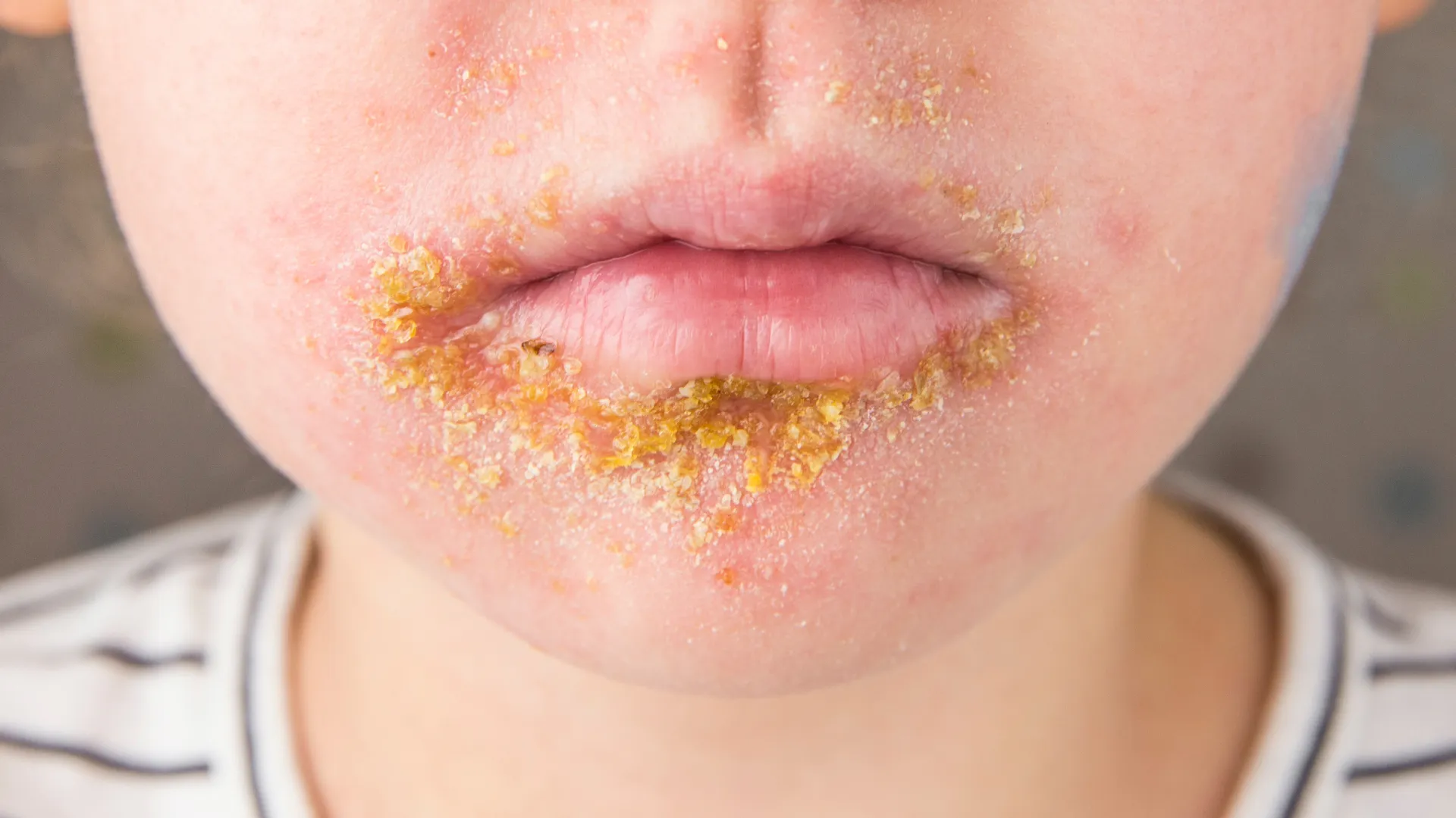 Μολυσματικό κηρίο στο στόμα ενός παιδιού