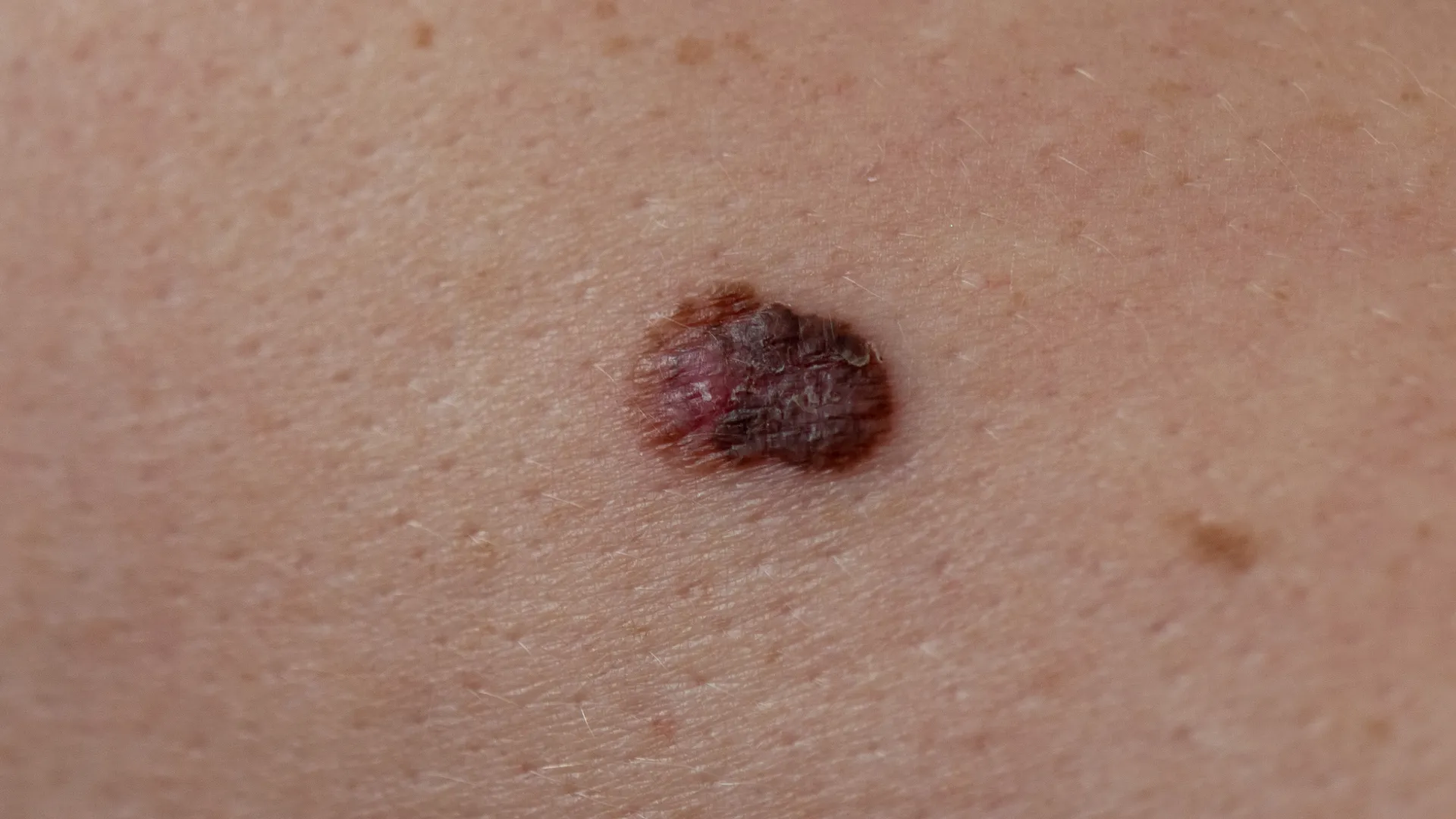 Μελάνωμα στο δέρμα