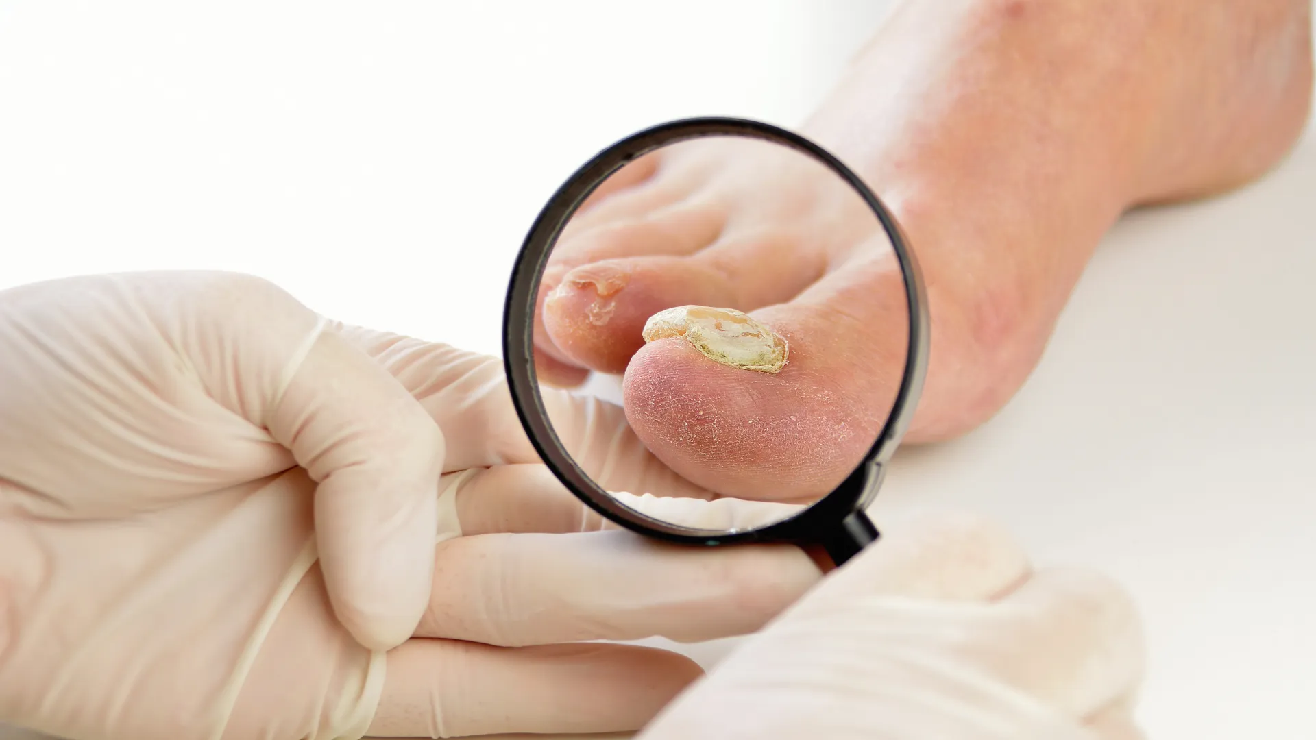 Μυκητίαση στο δάκτυλο ποδιού ενός ανθρώπου