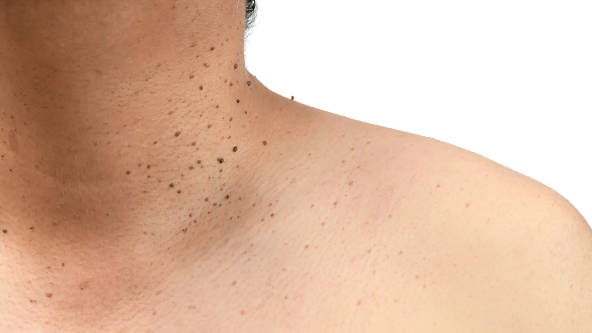 Θηλώματα στον λαιμό ενός ανθρώπου