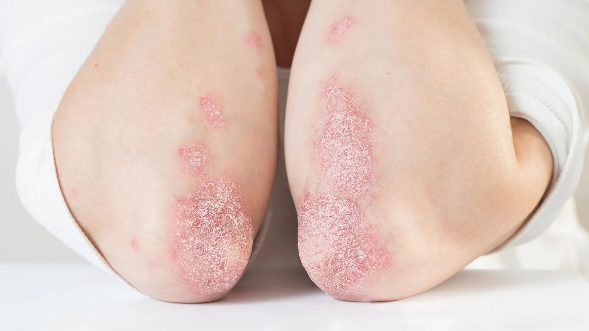 Ψωρίαση σε αγκώνα