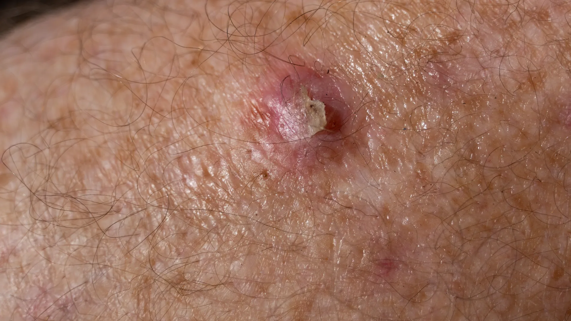 Ακανθοκυτταρικό καρκίνωμα στο δέρμα