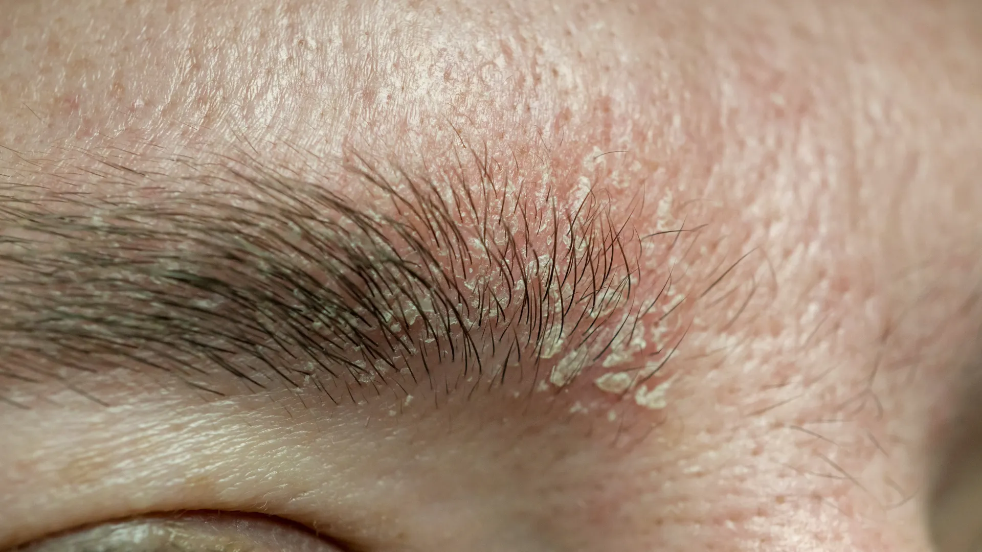 Σμηγματορροϊκή δερματίτιδα σε φρύδια