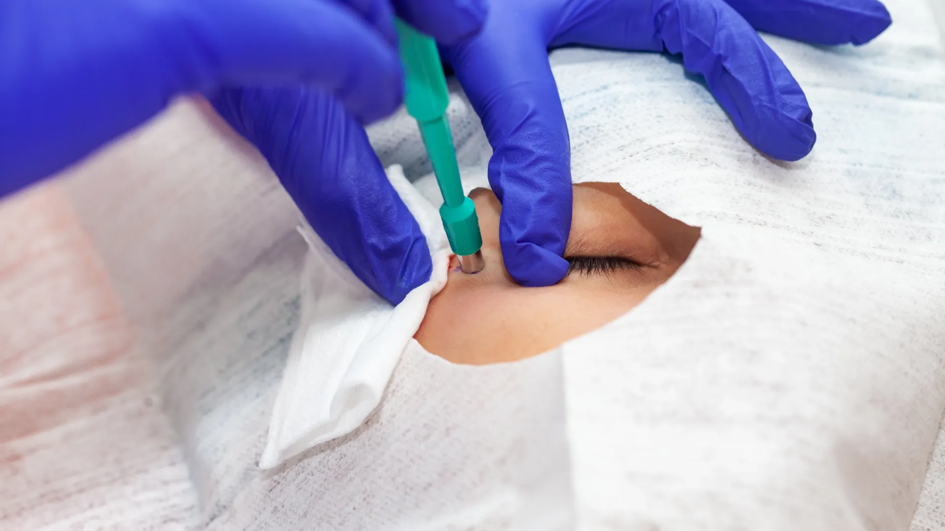 Λήψη δείγματος δέρματος για βιοψία με εργαλείο