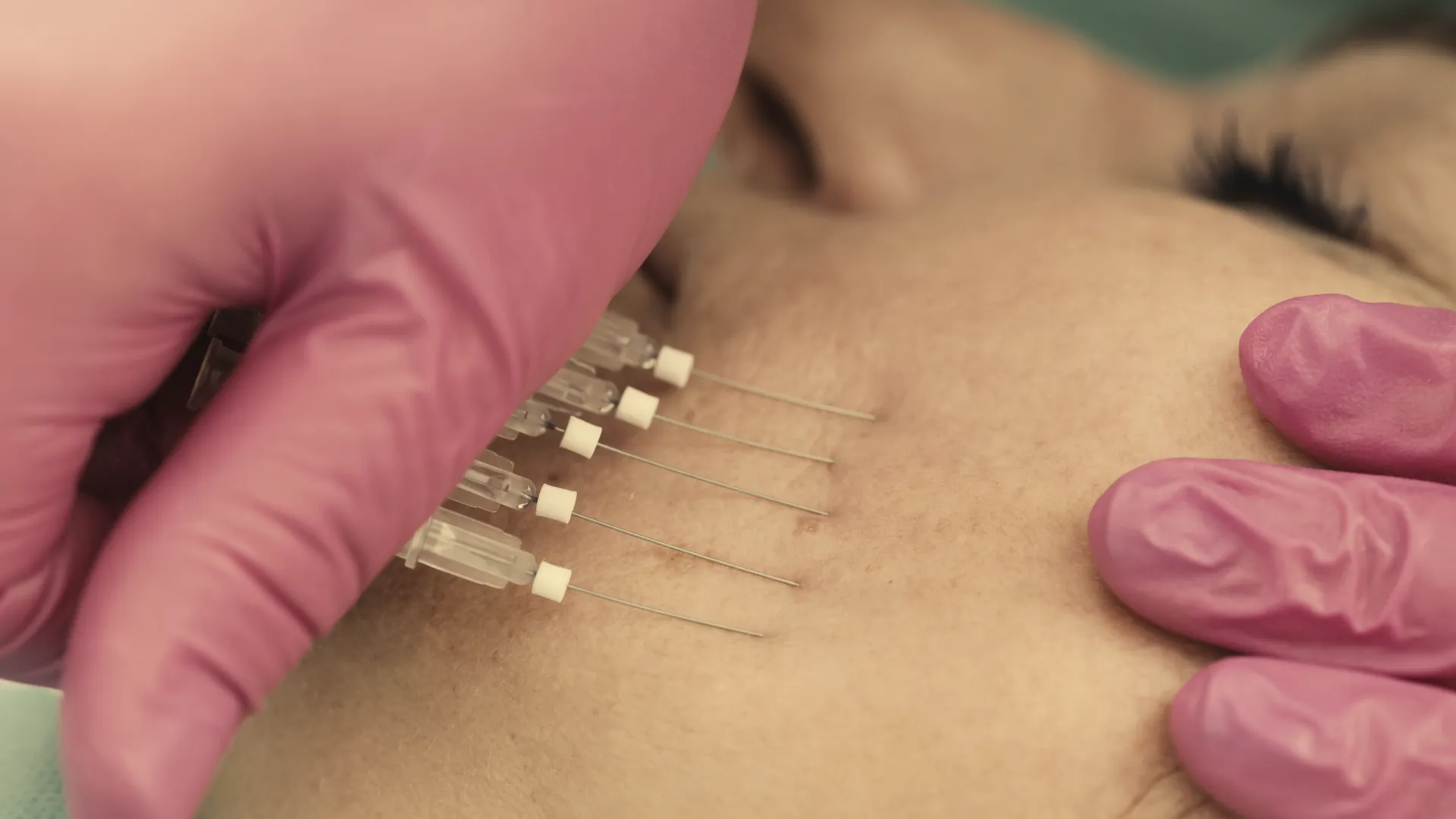 Νήματα στο πρόσωπο