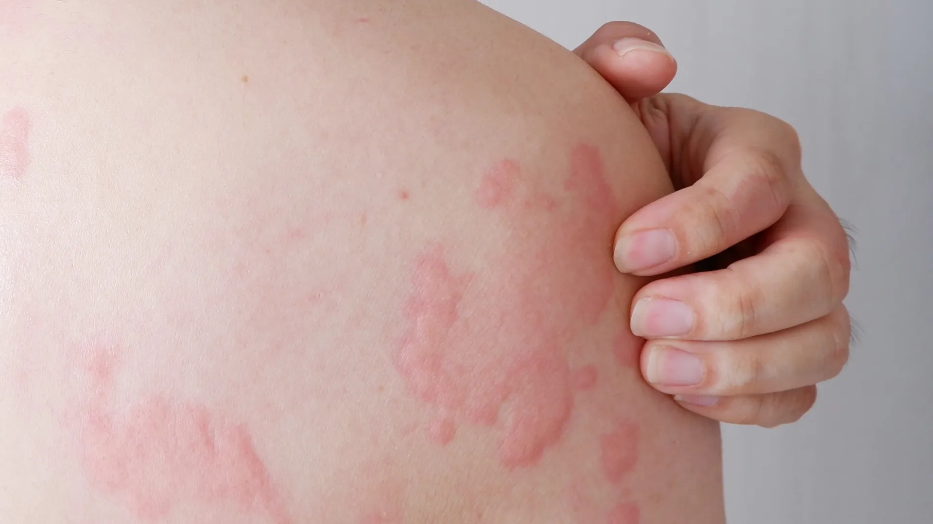 Κνίδωση στην πλάτη