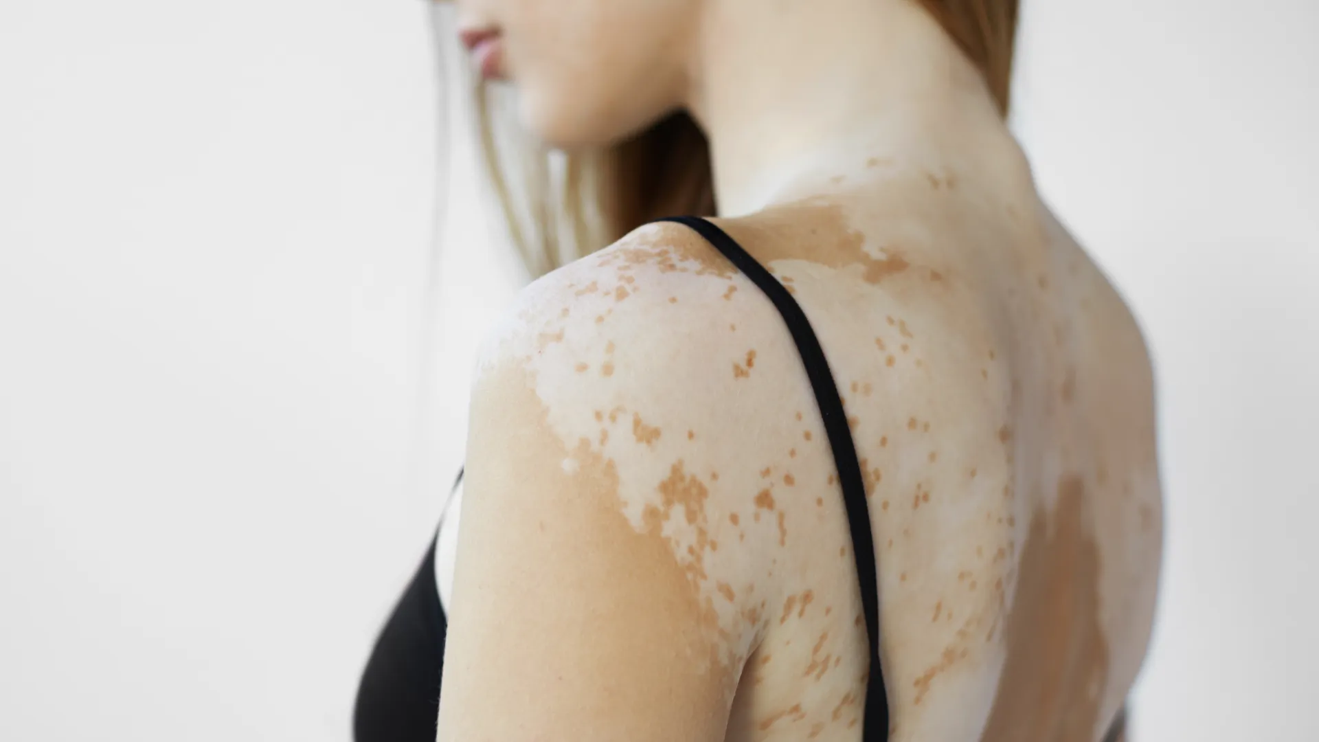 Λεύκη στο σώμα μιας νεαρής γυναίκας