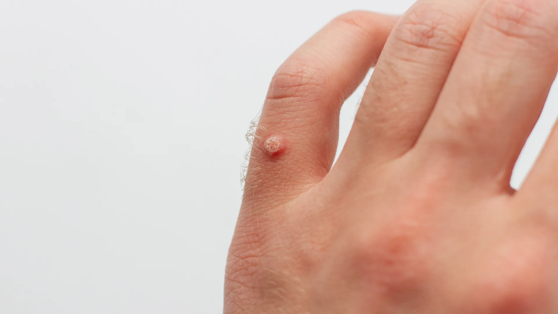 Μυρμηγκιές στο χέρι ενός ανθρώπου